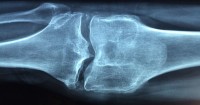 Previeni l'osteoporosi mangiando questi cibi